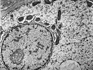 F,1y. | glycogenosis type II.(glycogen dissolved due to UA blockstaining)